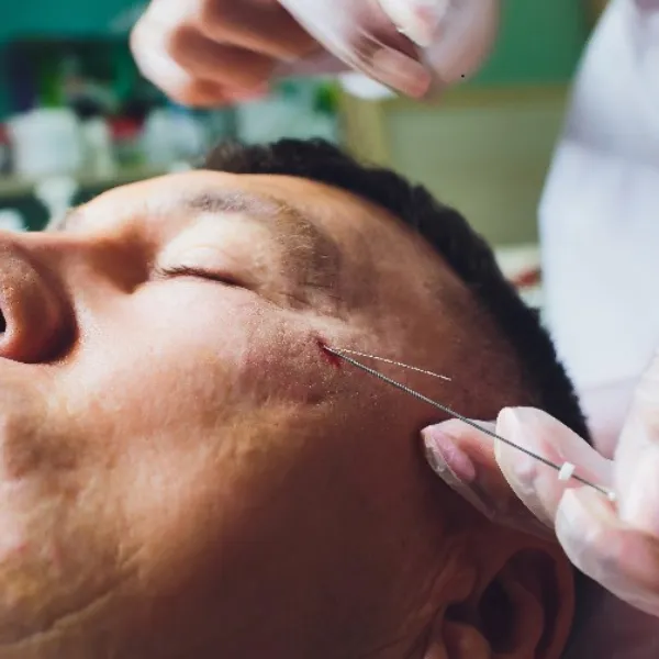 Thread lift treatment & Face lift treatment at Rivo