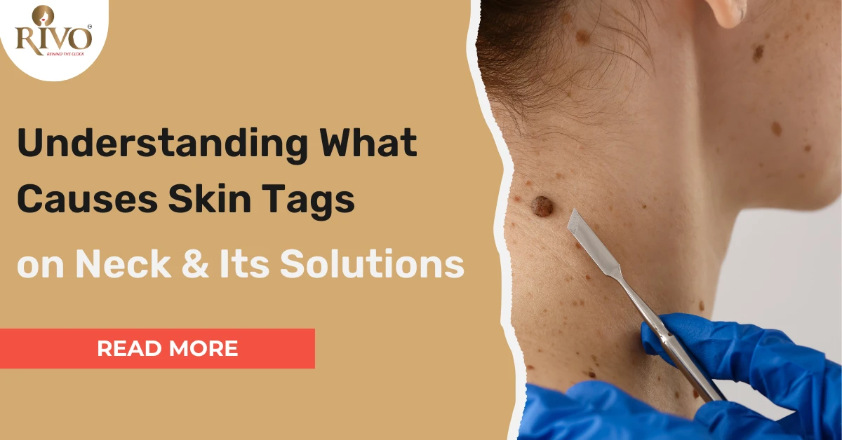 What Causes Skin Tags On Neck And Its Solution Whole Guide
