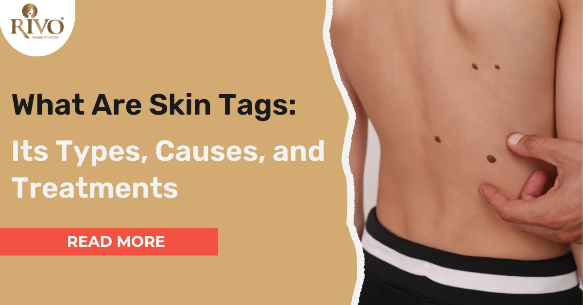 What Are Skin Tags: Its Types, Causes, and Treatments