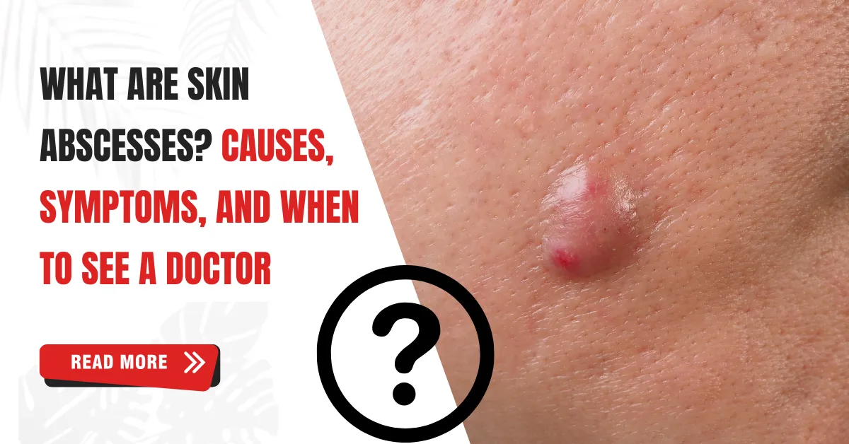 What Are Skin Abscesses? Causes & Symptoms