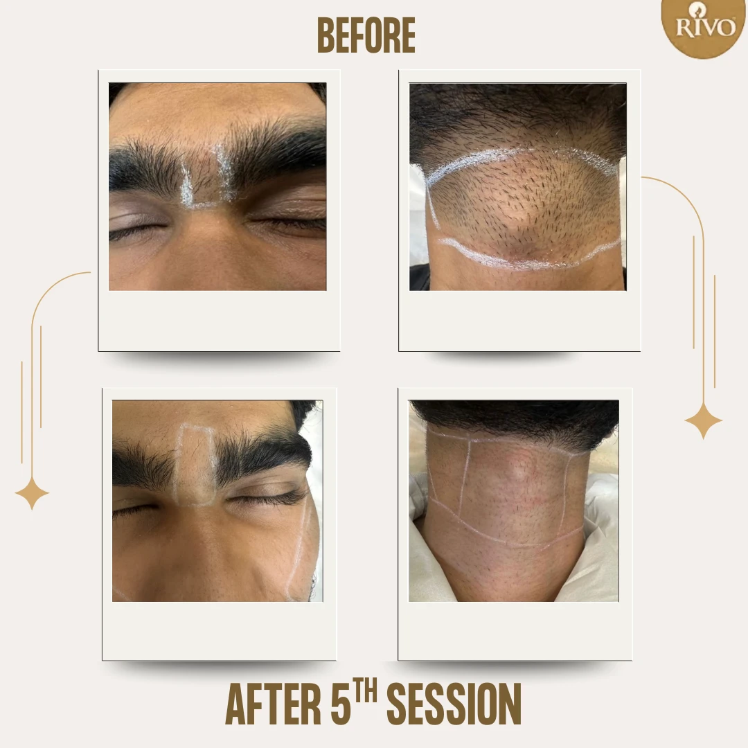 Before After - LHR (Dec 25)