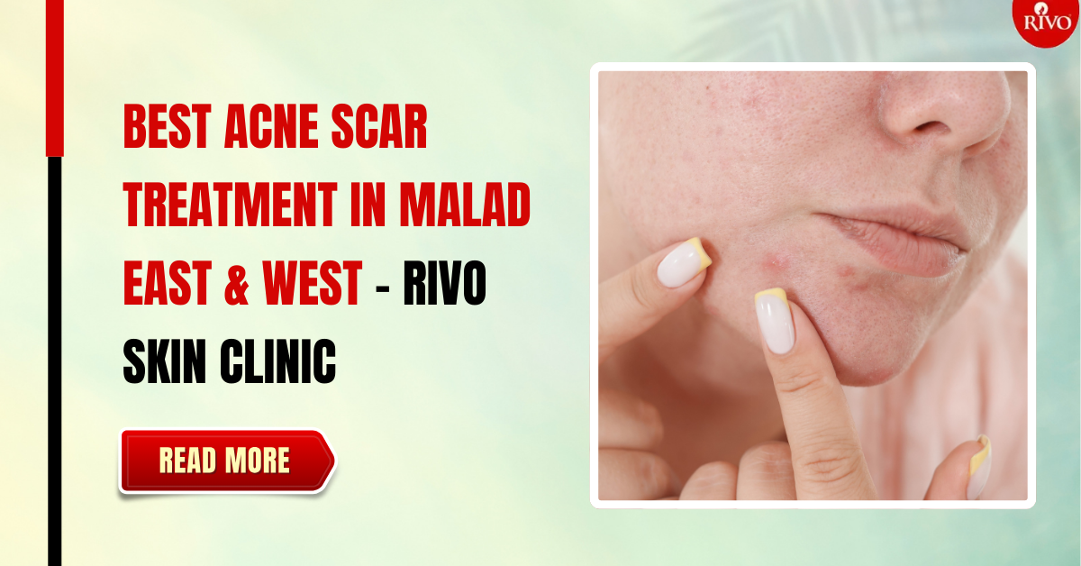 best-acne-scar-treatment-in-malad