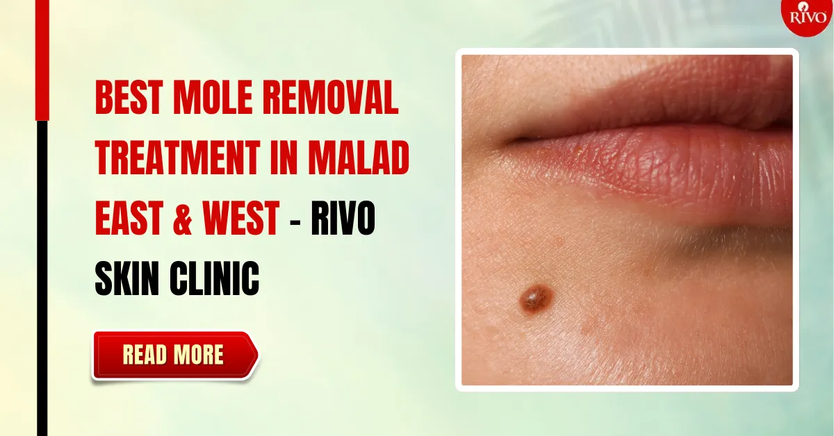 Best Mole Removal Treatment in Malad East & West - Rivo Skin Clinic