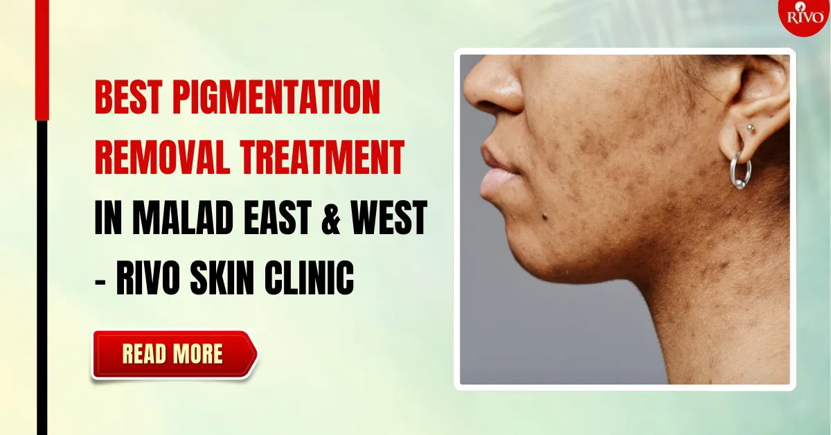 Best Pigmentation Removal Treatment in Malad