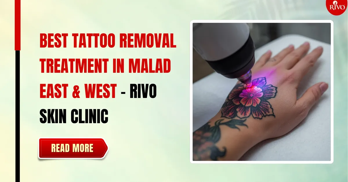 Best tattoo removal treatment in malad - Rivo Clinic