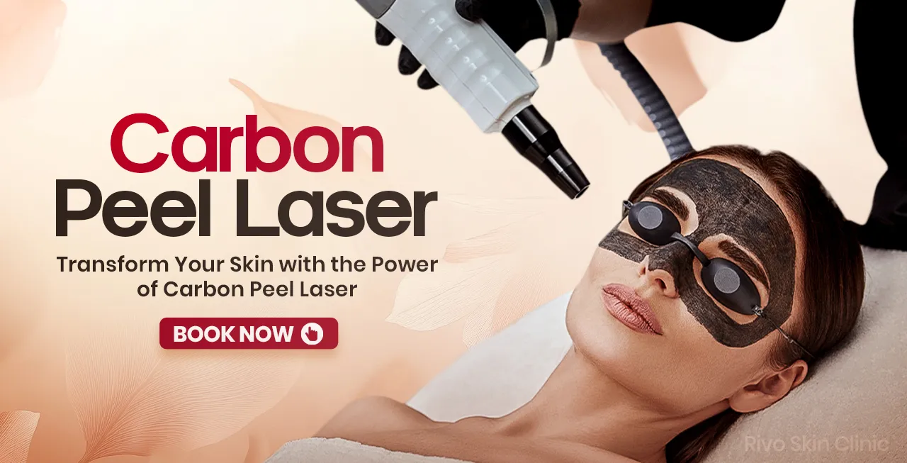 Carbon Peel Laser - Banner