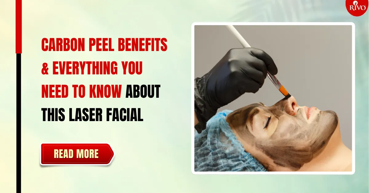 carbon-peel-benefits